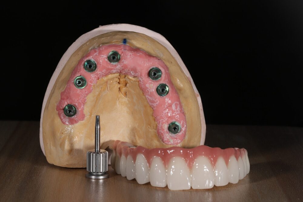 prf bone grafting Willoughby Hills